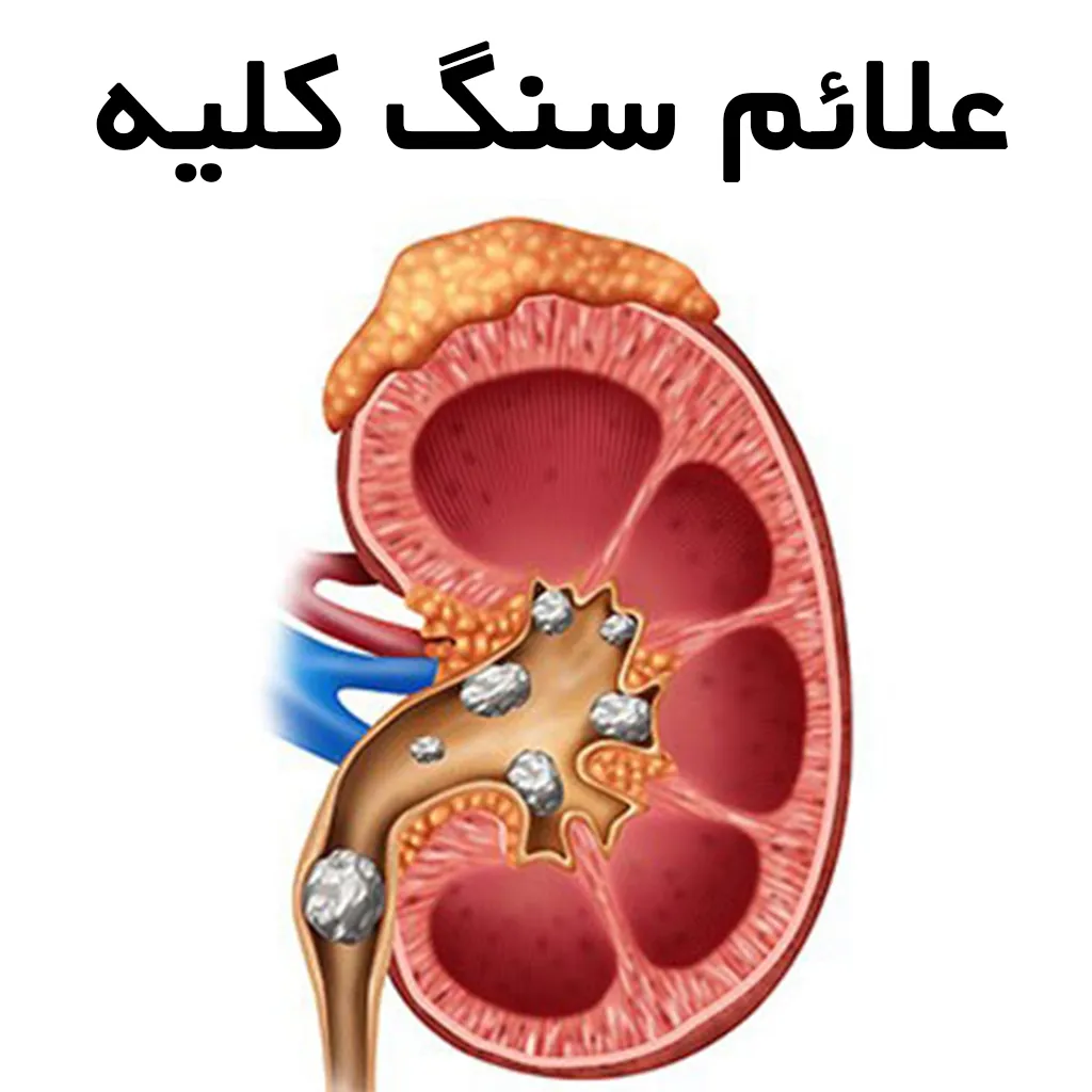 سنگ کلیه چیست ؟