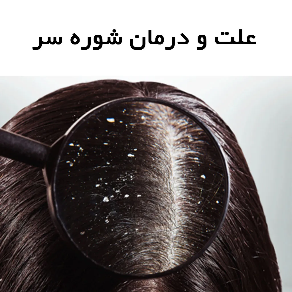 علت و درمان شوره سر